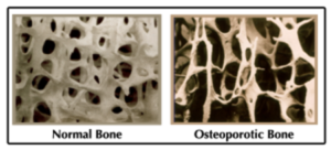 Picture of normal bone, showing thick bone tissue, in comparison to picture of osteoporotic bone, showing thin and brittle bone tissue